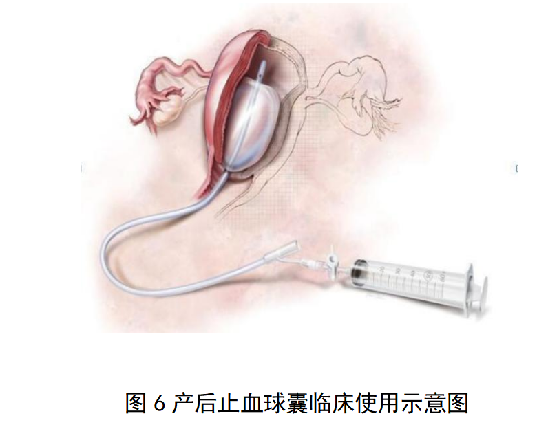 一次性使用球囊子宫支架审评要点（征求意见稿）(图7)