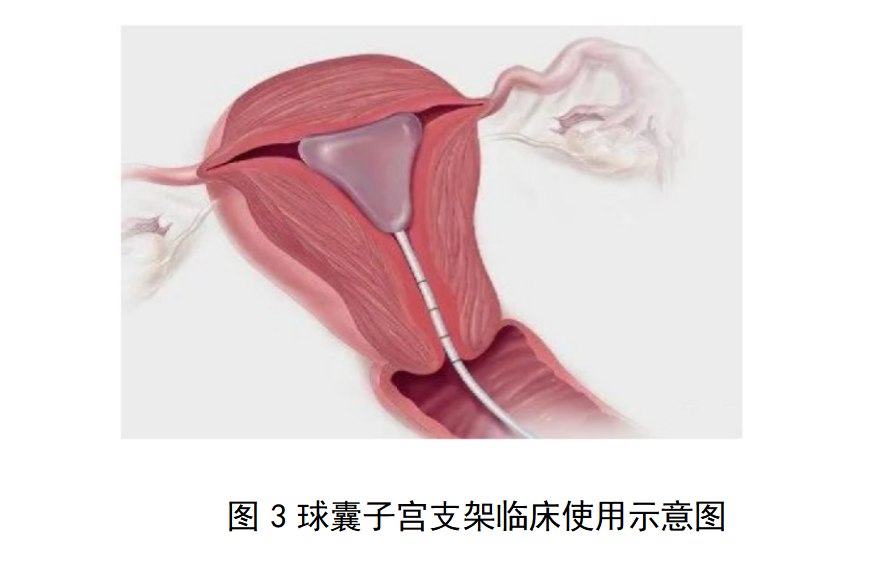一次性使用球囊子宫支架审评要点（征求意见稿）(图4)