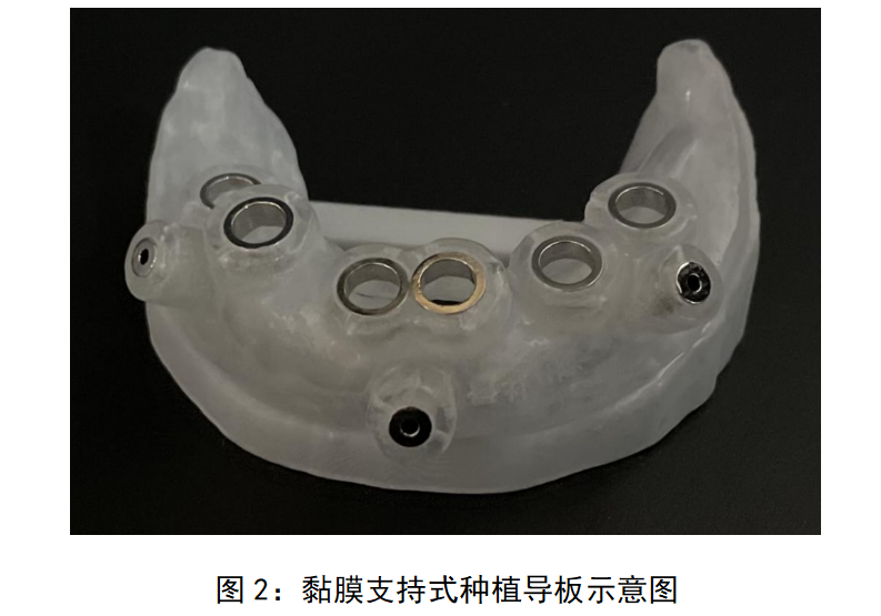 牙科种植用导板注册审查指导原则(征求意见稿)(图2) image.png