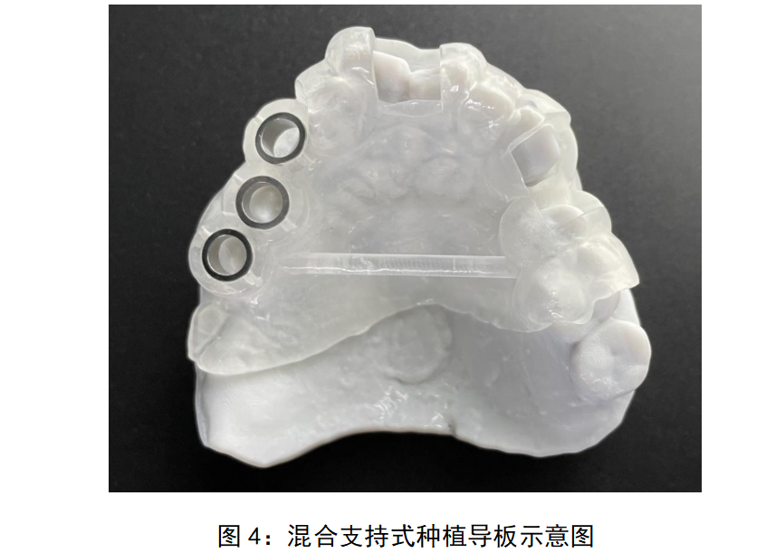 牙科种植用导板注册审查指导原则(征求意见稿)(图4) image.png