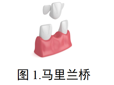 临时冠/桥注册审查指导原则(征求意见稿)(图1) image.png