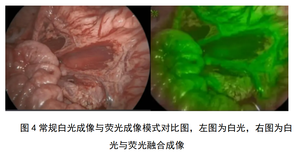 内窥镜图像采集与处理设备注册审查指导原则(征求意见稿)(图4) 内窥镜图像采集与处理设备注册审查指导原则(征求意见稿)(图4)